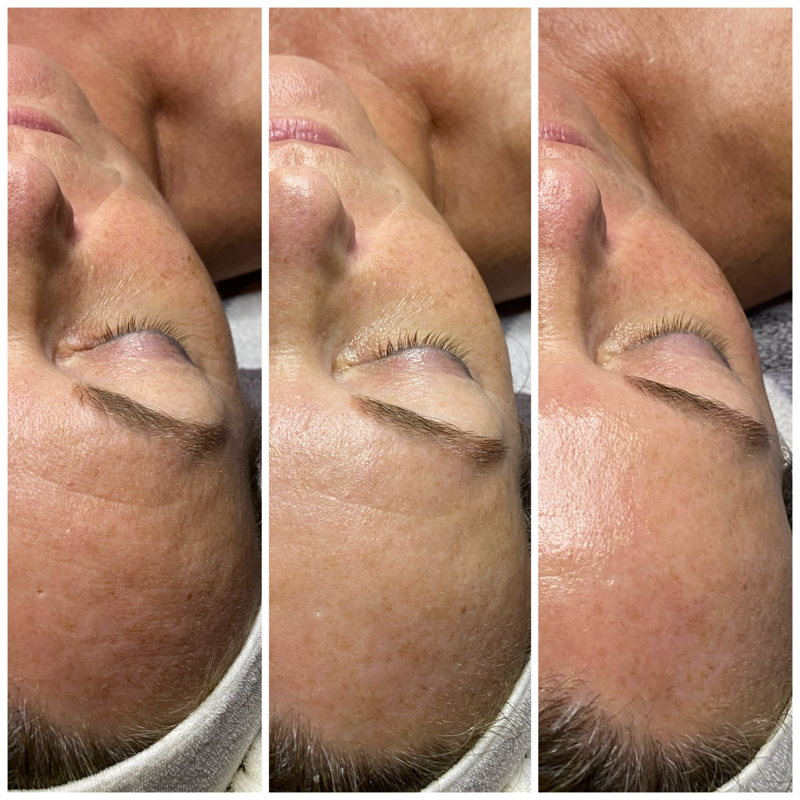 Belico professional deep peeling facial 